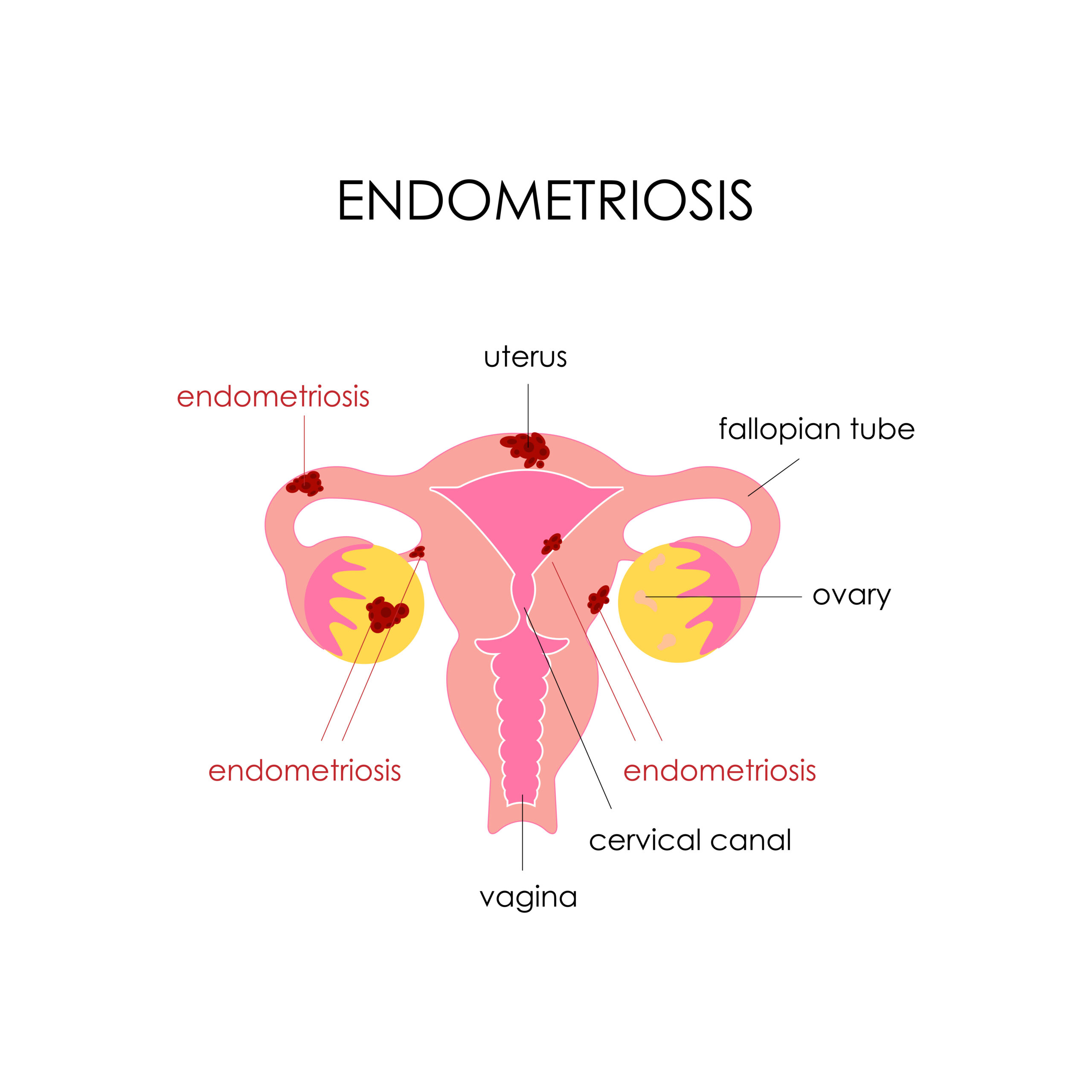 Endometriosis