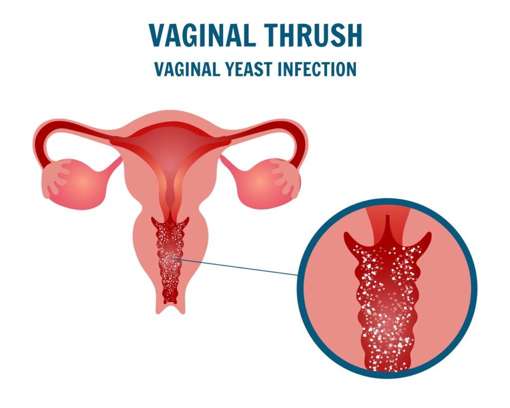 Vaginal Infections